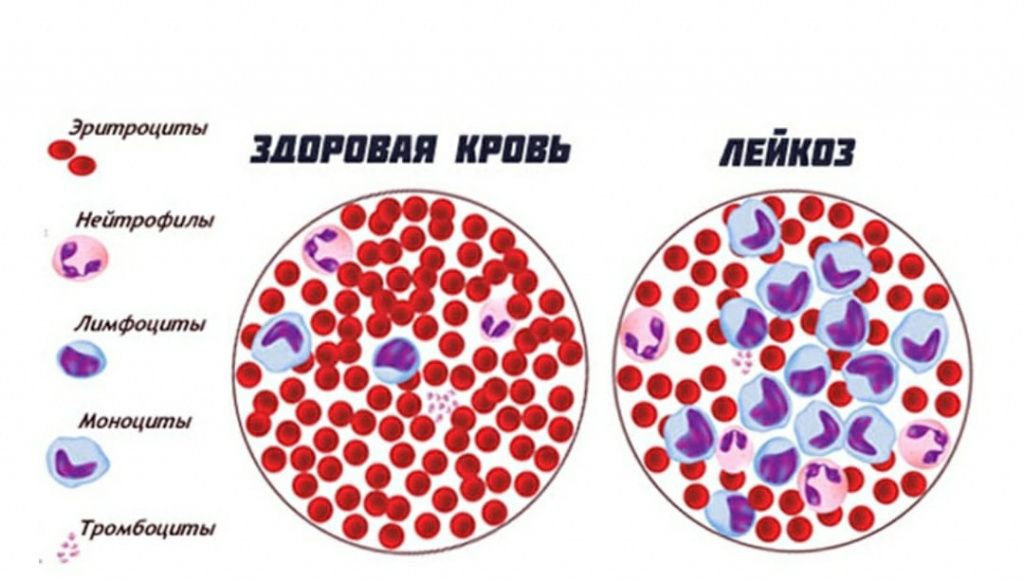 Лечение лейкоза